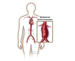 Abdominal Aortic Aneurysm Society For Vascular Surgery