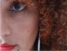 Image result for Solar Lentigo