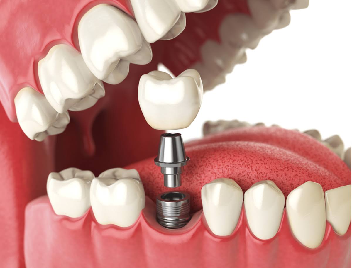 Dental Implant product image