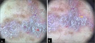 Image result for Dermoscopy