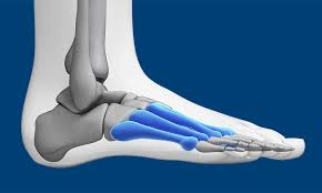 Top of the foot pain picture gallery: Metatarsalgia Or Forefoot Pain Run And Become