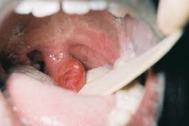 Image result for Uvulitis