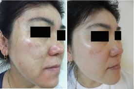The skin has reduced the appearance of mottled areas, dryness, and fine lines. Tretinoin Peel For Face Springerlink