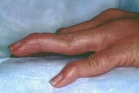 Rheumatoid arthritis is an autoimmune disease that attacks the cells that lines your joints. Rheumatoid Arthritis Ra Practice Essentials Background Pathophysiology