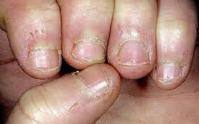 Hongos En Las Uñas De Las Manos Como Eliminarlos Pin De Sergio Morales En House Remedios Hongos Unas Eliminar Hongos De Las Unas Hongo En Las Unas