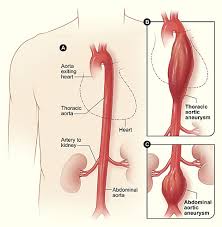 Aortic Aneurysm What You Need To Know Myheart