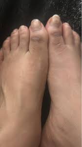 Image result for brown patches on the feet