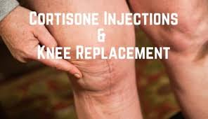 See full list on mayoclinic.org Cortisone Injections Before Knee Replacement My Experience