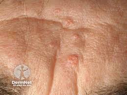 Image result for Sebaceous Gland