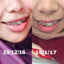 Alhamdulillah satu impian nad untuk tahun 2018 ni dah tercapai semalam, iaitu pakai braces! Harga Gigi Palsu Di Klinik Swasta 2020