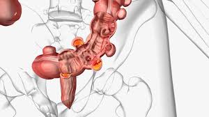 Image result for Diverticulitis