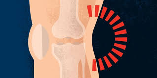 Pain Behind The Knee Posterior Pain Health Information Bupa Uk