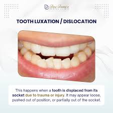 Image result for Tooth Luxation