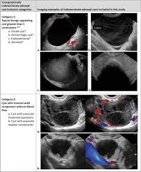 Ovarian cancer includes a heterogeneous group of malignancies that arise from the various cell transvaginal ultrasound allows for improved morphologic characterization of pelvic masses. Indeterminate Adnexal Cysts At Us Prevalence And Characteristics Of Ovarian Cancer Radiology