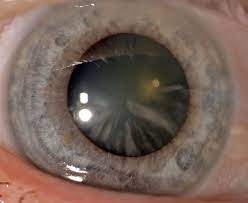 A homályok a lencse peremén alakulnak ki. Bilder Vom Grauen Star Auge Online