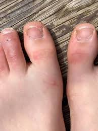 Otc and prescription medications may be necessary. Dermatologist Explains If Covid Toes Skin Rashes Are Symptoms Tied To Virus Infection Wkrc
