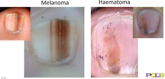 Image result for Acral lentiginous melanoma nail