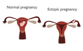 Bonjour siana, il parait plus probable que ce saignement soit une réaction à l'oubli de la pilule, mais vous pouvez refaire un test pour en avoir le coeur net, au moins 2 semaines après le rapport. Grossesse Extra Uterine Symptomes Risques Et Traitements