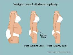 … this is why medicare does not simply pay for all of these operations. Tummy Tuck Tijuana Low Cost Abdominoplasty In Mexico