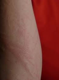 But that's just a quick answer. Hot Tub Rash All You Need To Know Aquatech Utah