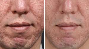 Draw out your skin's own rejuvenating power with the micropen treatment — our way of giving nature a nudge… answer yes to any of these questions, and the skinpen microneedling™ could be the perfect choice to help improve the appearance and health of your skin. Microneedling For Acne Scars Effectiveness Side Effects And Costs