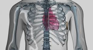 Feb 13, 2012 · the international classification of diseases (icd) is designed to promote international comparability in the collection, processing, classification, and presentation of mortality statistics.this includes providing a format for reporting causes of death on the death certificate. Subcutaneous Icd Holds Up Well Against Transvenous Devices Tctmd Com