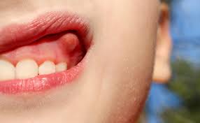 swollen gums remedy hyster home