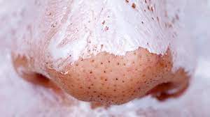 Do this to remove blackheads from your nose youtube. Those Tiny Black Dots On Your Face Aren T Blackheads So Um What Are They Stellar