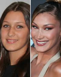 Bella Hadid Before and After: From 2010 to 2024