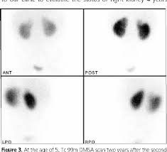 The presence of several sulphur. Figure 3 From Is Imaging Time Between Two Tc 99m Dmsa Scans Sufficient For Reporting As Renal Parenchymal Scarring Healed Parenchymal Renal Defect After 6 Years Semantic Scholar