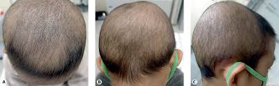 My hair is thinning since the summer. Hair Loss Pattern Due To Chemotherapy Induced Anagen Effluvium A Cross Sectional Observation Semantic Scholar
