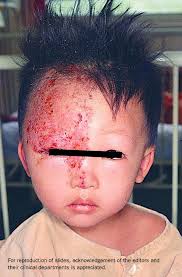 Image result for shingles in children