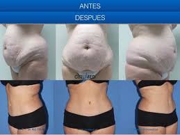 Pin On Mommy Makeover Tummy Tuck Abdominoplastia