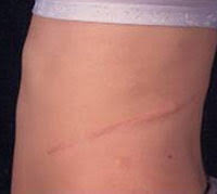 Minimally Invasive Urological Surgery Central Coast Laparoscopic Urology North Gosford