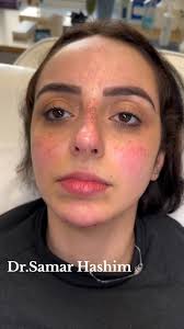 مع بداية السنة الجديدة، خلي جمالك يتجدد! 💖, استمتعي بأفضل العروض على  البوتوكس، الفيلر، وحقن النضارة في عيادة دكتور سمر هاشم وكوني دايمًا في أجمل  طلة. 💉💫 , للحجز والاستفسار : 01555006904, 📌عناوين ...