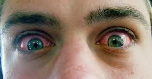 Why Does Marijuana Make Your Eyes Red Green Rush Daily