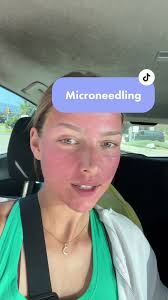 Healing up nicely! . . #microneedling #microneedlingbeforeandafter  #accutanejourney #postaccutane