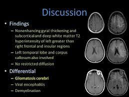 Gliomatosis Cerebri Radiology Google Search In 2020 White Matter Radiology Greater Than