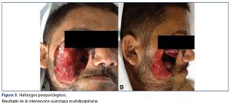 Habitualmente aparece en pacientes con algún tipo de inmunodeficiencia (diabéticos, pacientes con sida o a tratamiento con fármacos inmunosupresores). Tratamiento Exitoso De Mucormicosis Rino Orbito Cerebral En Un Paciente Trasplantado Renal