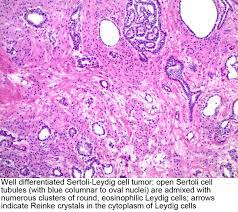 All indices were significantly elevated not only in undescended but in contralateral scrotal testes of the cryptorchid patients in comparison to those in normal controls. Pathology Outlines Sertoli Leydig Cell Tumor