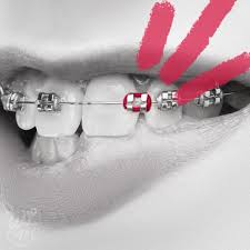 You can only choose the color of the rubber band. Frequently Asked Questions