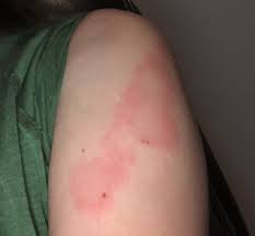 Reddish and purplish bumps on the fingers or toes, which may be sore but not usually itchy. Covid Arm Moderna Vaccine Rash A Harmless Side Effect Doctors Say