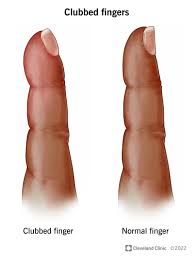 Image result for Clubbing nails feet