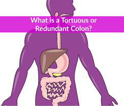 Tortuous Colon Diet Symptoms Diagnosis Treatment