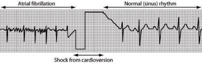 A small clip on your finger measures the amount of oxygen in your blood. Electrical Cardioversion Treatment Side Effects Recovery