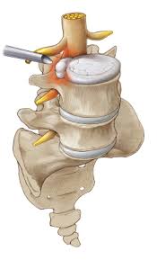 La colonne vertébrale, à la fois très solide et particulièrement mobile, constitue le. Chirurgien Du Rachis Specialisee Clinique Orthopedique Arthrose Com