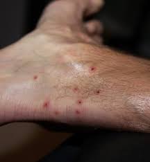 If fleas are biting you, you should be able to see them; Fleas On Humans Should You Be Concerned Fullscope Pest Control