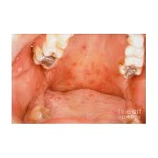 Image result for Oral herpes roof of mouth