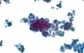 Malignant mesothelioma, also mesothelioma, is a form of cancer. Mesothelioma Cytology Malignant Cancer Diagnosis By Fluid Sample