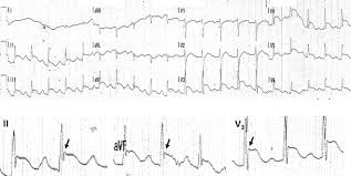 Image result for Early Repolarization